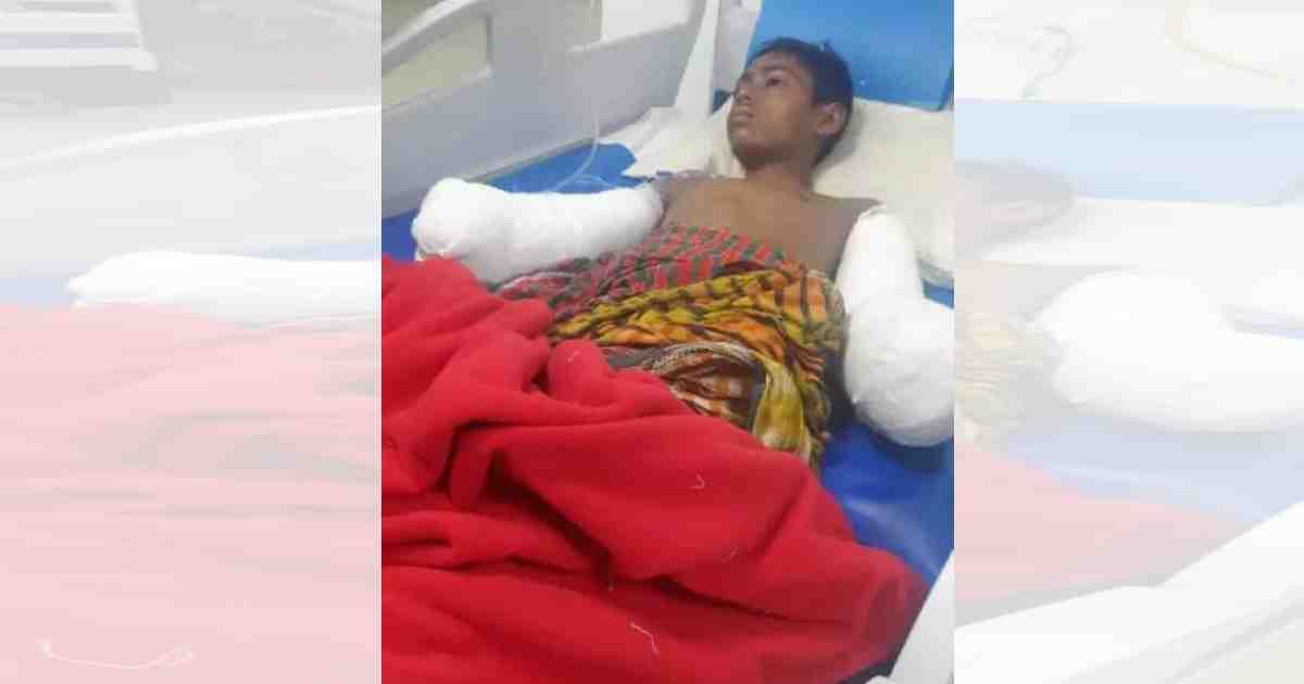 পল্লী বিদ্যুতের ‘গাফিলতিতে’ দুটি হাত হারাল সাব্বির