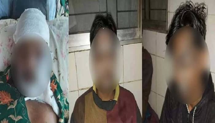 ফরিদপুরে প্রতিপক্ষের এসিডে এক পরিবারের দগ্ধ ৩