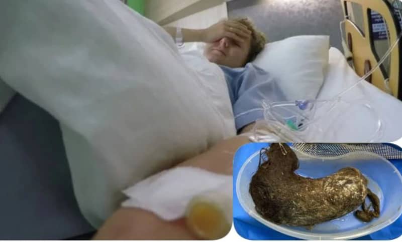 কিশোরীর পেটে ছিল ৪৮ সেন্টিমিটার লম্বা চুল!