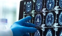 copper drug Alzheimer's