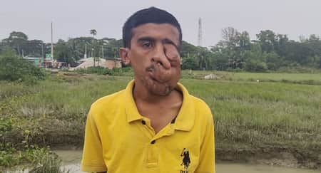 প্রতিদিন বাম পাশের চোখ ও মুখের মাংস ঝুলে পড়ছে রিপনের