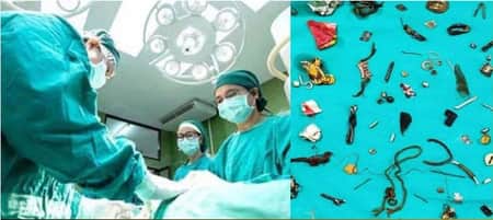 এক ব্যক্তির পেট থেকে বের হলো ১০০টি ধাতব বস্তু