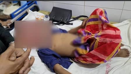 এবারে নোয়াখালীতে সুন্নতে খতনায় ভুল, পালাল ডাক্তার