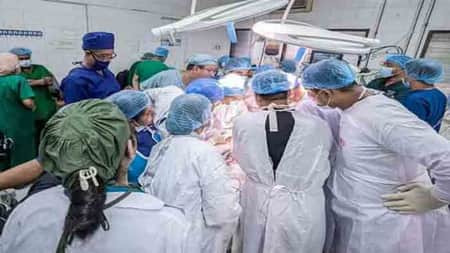 ৮০ জন চিকিৎসকের ১০ ঘণ্টার চেষ্টায় আলাদা হলো জমজ দুই শিশু DR