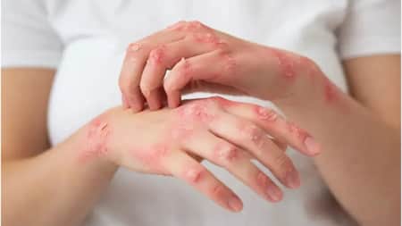 স্ক্যাবিস কী