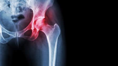 arthritis cartilage Stanford research