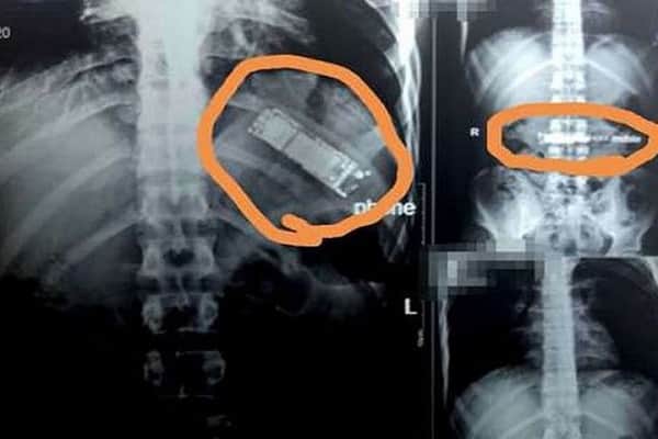 ৭ মাস ধরে যুবকের পেটে মোবাইল ফোন, হতবাক চিকিৎসকরা