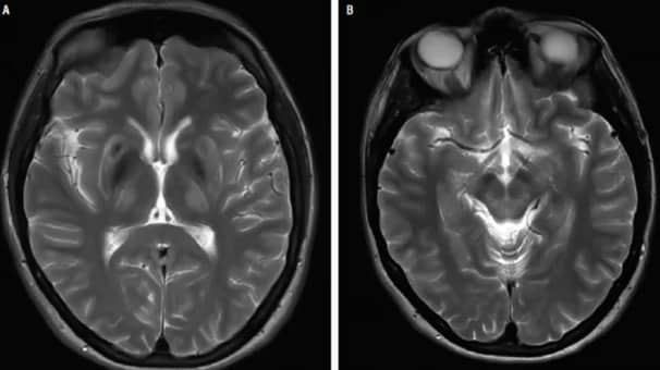 আত্মীয়ের মধ্যে বিয়ে হলে সন্তানের হতে পারে এই রোগ