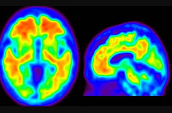 Copper Drug Cuts Alzheimer’s Toxic Proteins by 42 Percent in Lab Study