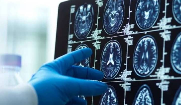 copper drug Alzheimer's