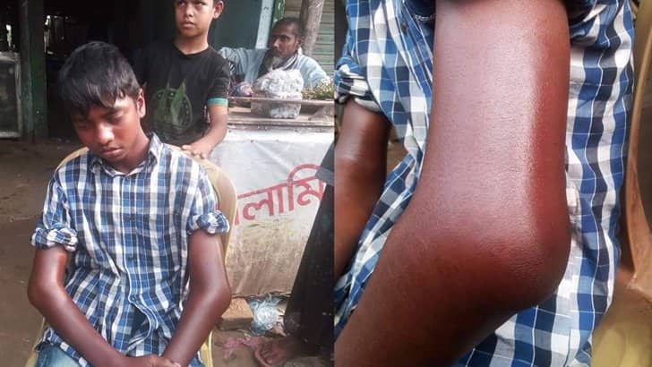 কিশোর রিকশাচালককে পিটিয়ে হাত ভেঙে দিল পুলিশ