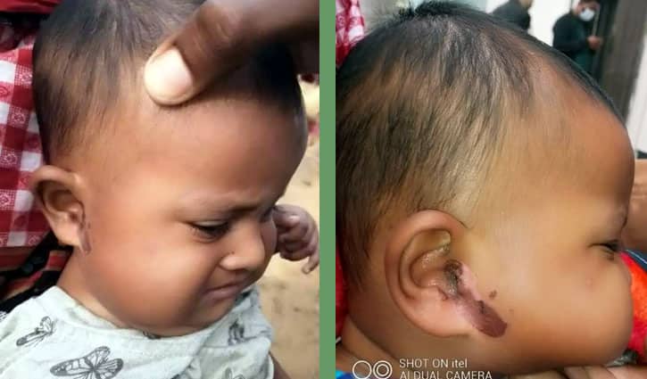 পারিবারিক বিরোধে শিশুকে এসিডে ঝলসে দিল প্রতিবেশী চাচী