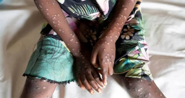 এমপক্স কী? কীভাবে ছড়ায়? এ রোগের লক্ষণ কী? Mpox