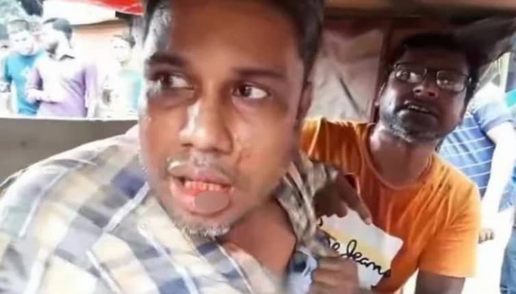 হাতুড়ি দিয়ে মোটারসাইকেল চালকের ৫ দাঁত ভাঙল অটোচালক অটোরিকশা চালকের হাতুড়িপেটা