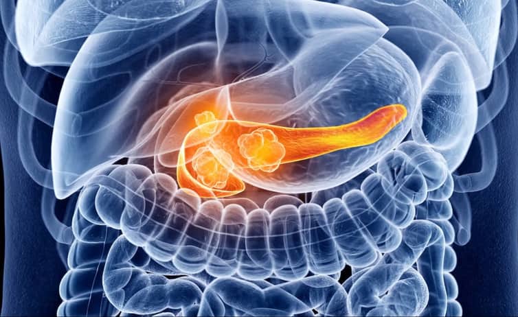 Pancreatic Cancer Trial