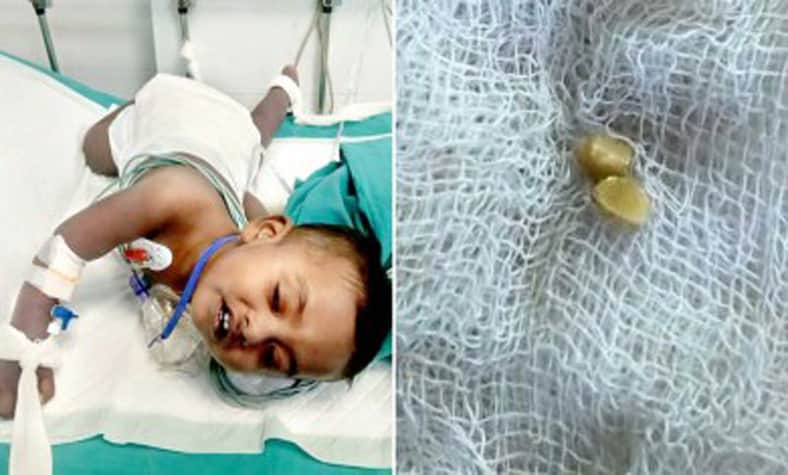 শ্বাসনালিতে বাদাম ঢুকে প্রাণ হারাতে বসেছিল শিশুটি