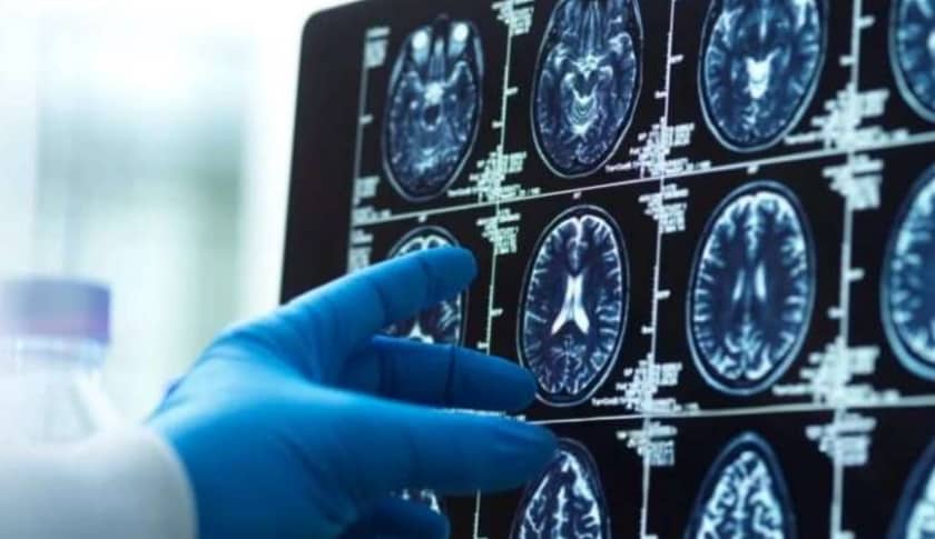 copper drug Alzheimer's