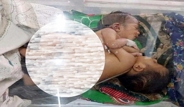 এক লিভার নিয়ে জন্ম জোড়া দুই বোনের