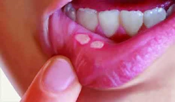 গনোরিয়া রোগে মুখের আলসার