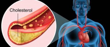 কোলেস্টেরল কিভাবে কমানো যায়