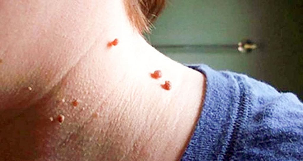 আঁচিল থেকে মুক্তি দেবে কচি আমপাতা আঁচিল