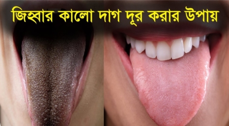 জিহ্বায় কালো দাগ