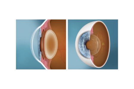 EVO Visian Implantable Collamer Lenses