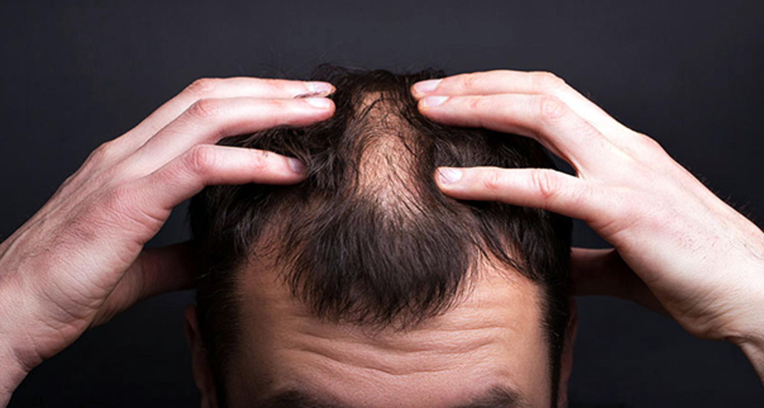 ছেলেদের চুল পড়া সমস্যা সমাধানের দারুন উপায় চুল পড়া