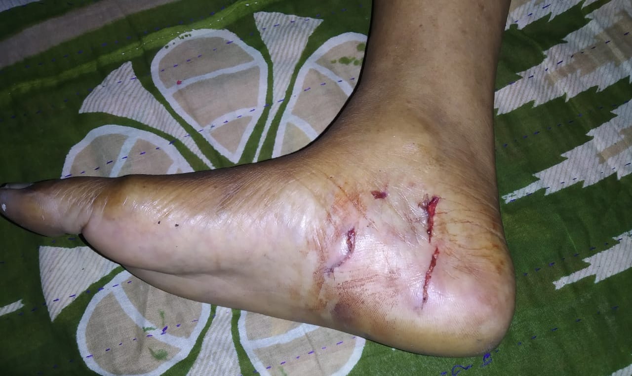 কালীগঞ্জে শিয়ালের কামড়ে নারীসহ আহত ৩