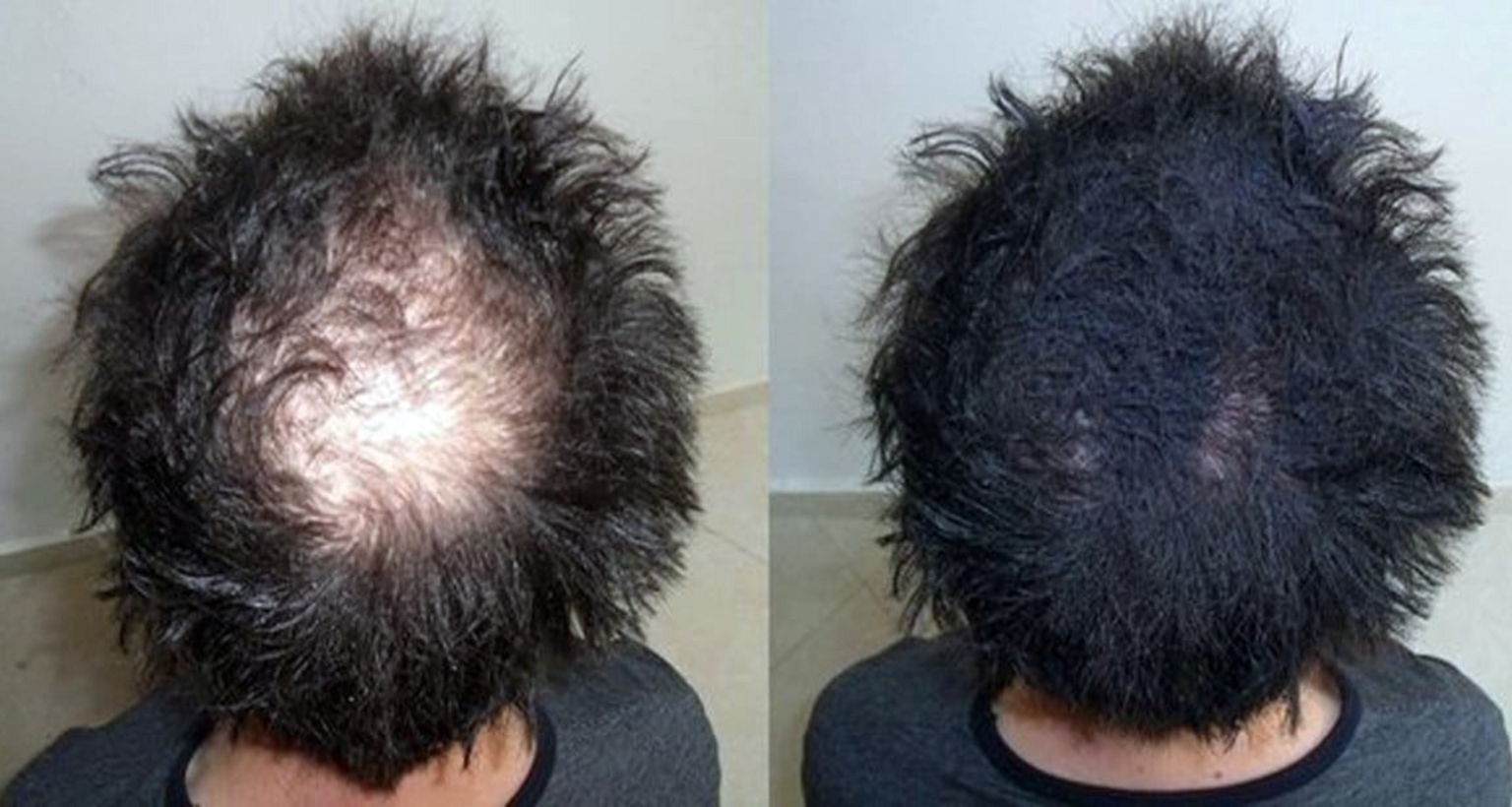 ঘরে বসেই এই মিশ্রণে ম্যাজিকের মত মাথায় চুল গজাবে চুল