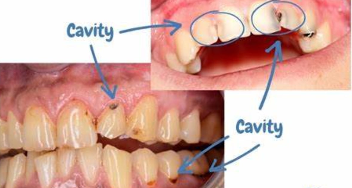 cavity