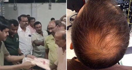 hair-loss-india