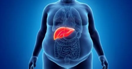 Fatty liver disease