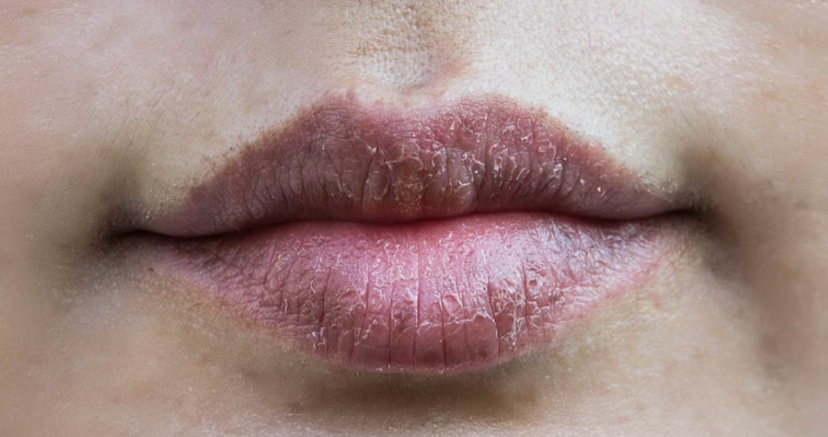 শীতে ঠোঁটের কালচেভাব যে রোগের ইঙ্গিত দেয়
