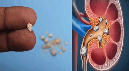 কিডনিতে পাথর