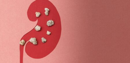 কিডনিতে পাথর