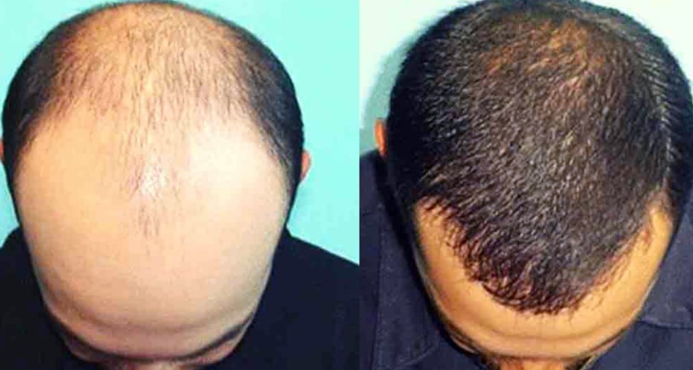 Hair Growth