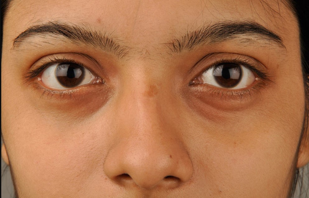 চোখের নিচে ফোলা ভাব দূর করার টিপস: সহজ সমাধান