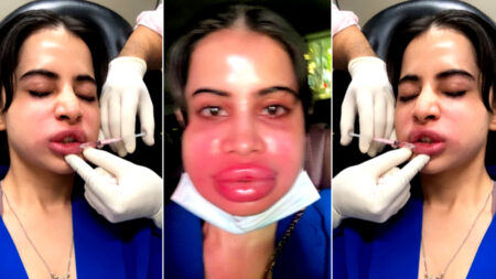 ঠোঁটে ব্যথা ও ফোলাভাব, কি সমস্যায় ভুগছেন উরফি জাভেদ? Urfi