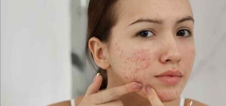 মুখের ব্রণ কমানোর ১০টি প্রাকৃতিক উপায় – ঘরোয়া সমাধানেই পাবেন মসৃণ ত্বক! মুখের ব্রণ কমানোর প্রাকৃতিক উপায়