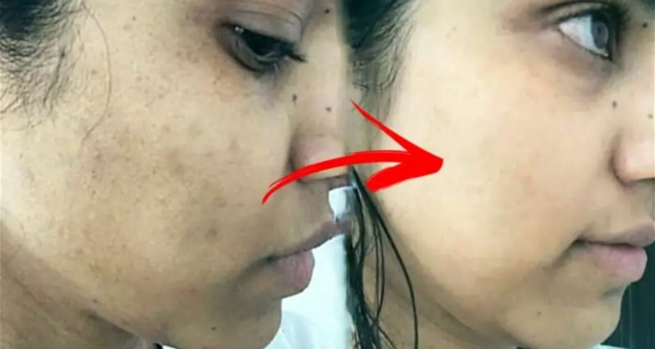 কালো দাগ