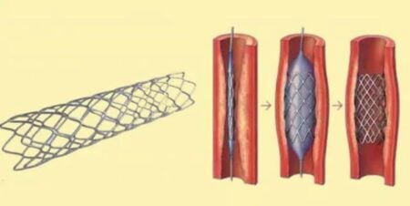 হার্টের রিংয়ের দাম