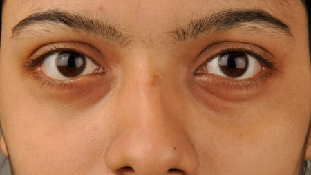 চোখের নিচের ফোলা ভাব