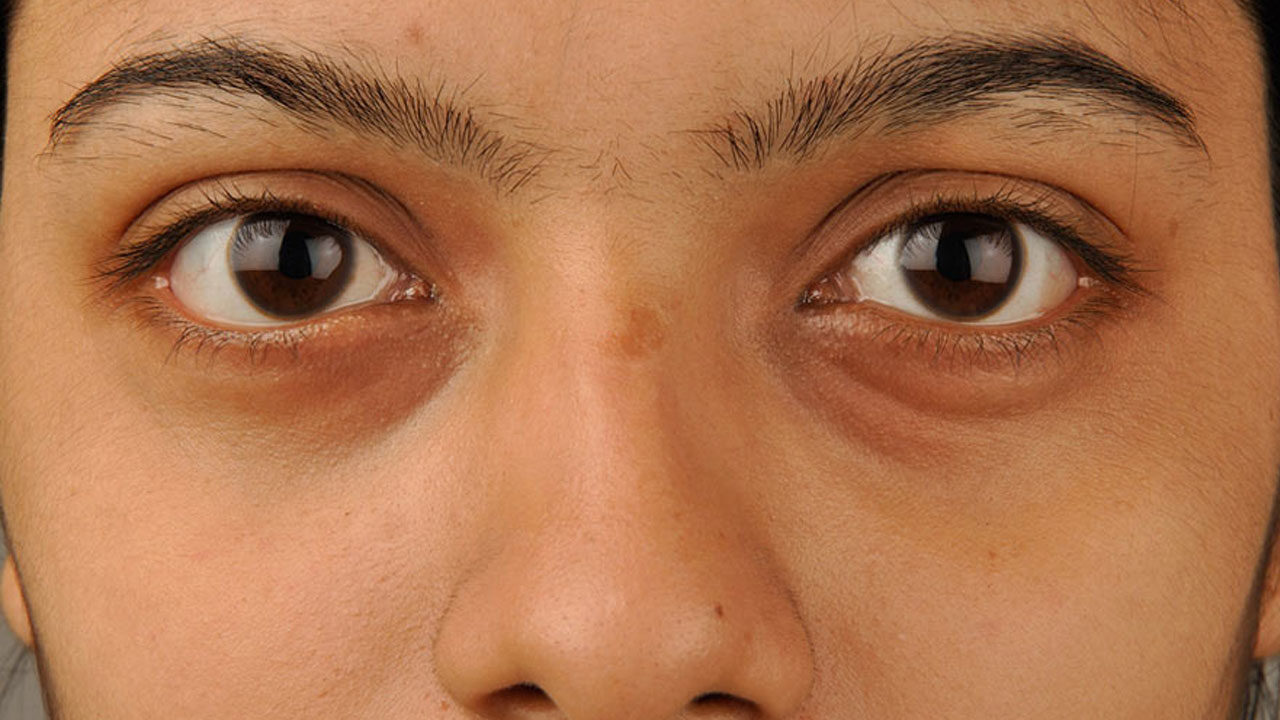 চোখের নিচের ফোলা ভাব