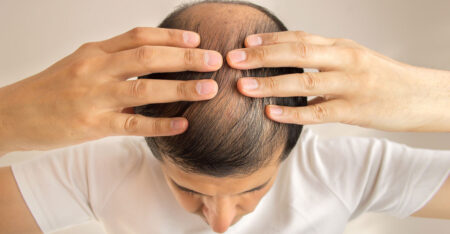 টাক পড়া রোধে প্রাকৃতিক তেল: সহজ সমাধান টাক পড়া রোধে প্রাকৃতিক তেল