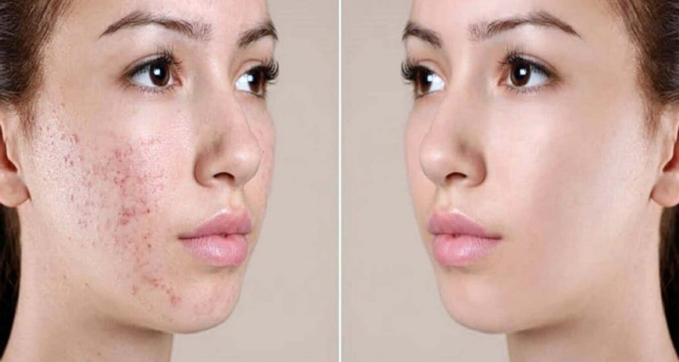 মুখের কালো দাগ