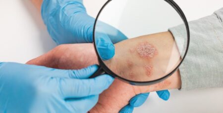 স্কিন ক্যানসার