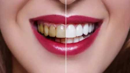 হলুদ দাঁত সাদা