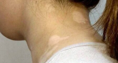 ছুলির দাগ