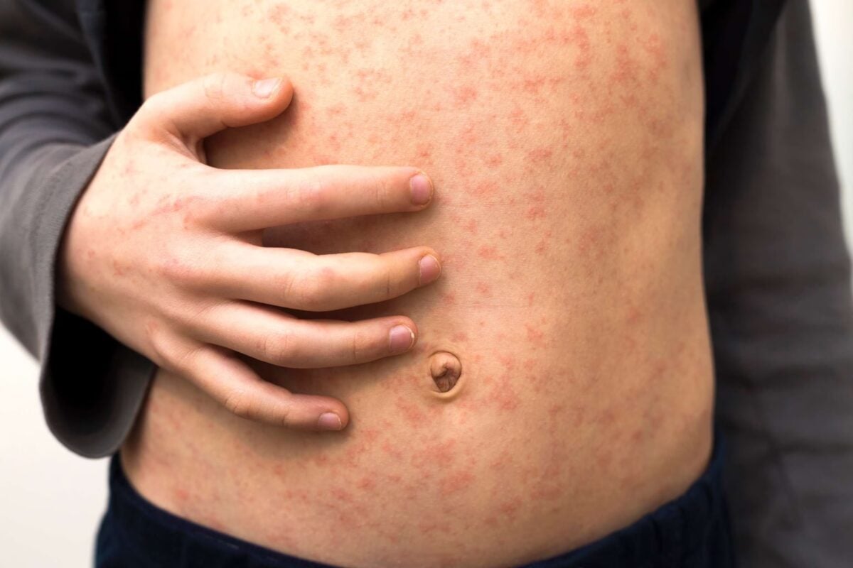 Measles outbreak US
